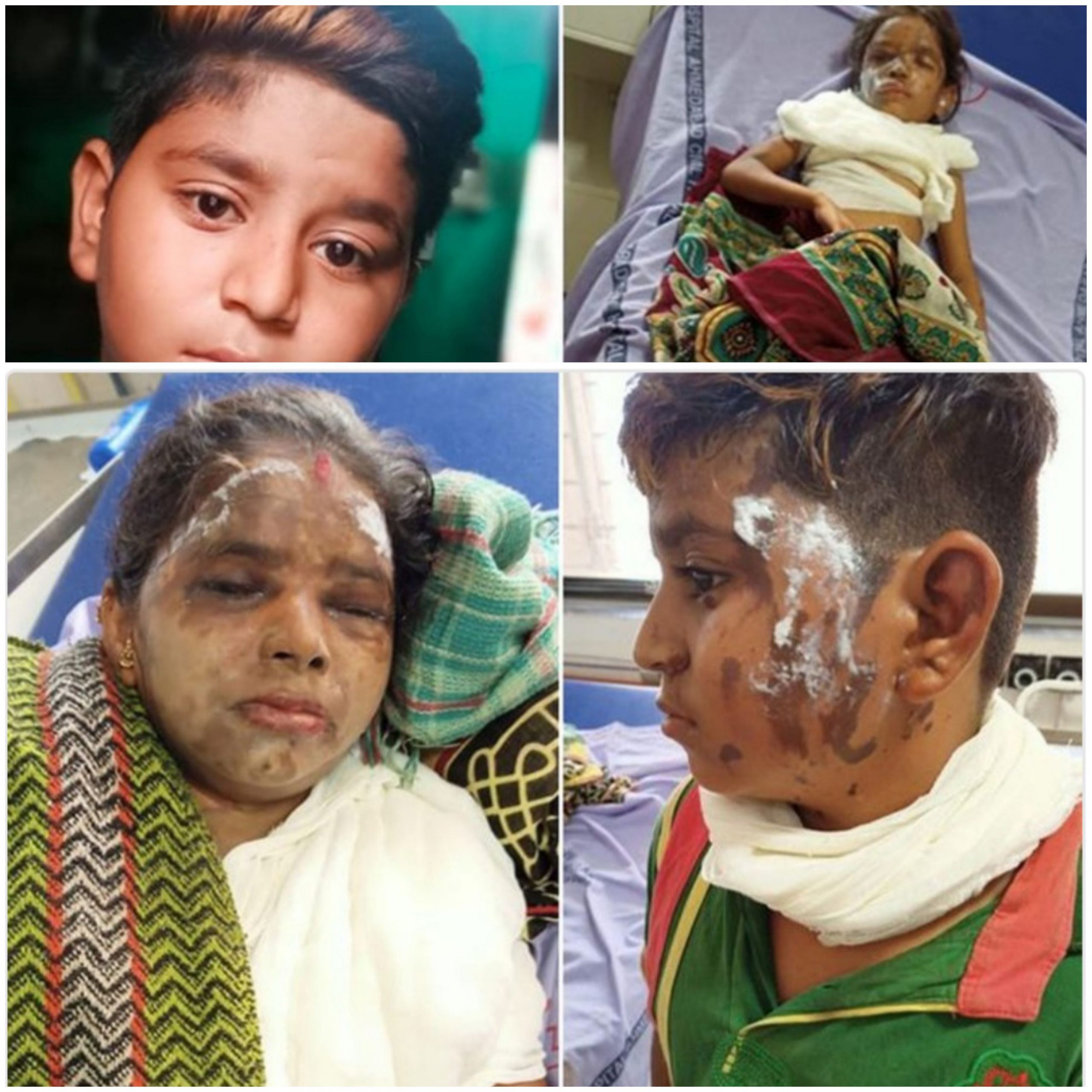 અમદાવાદ માં મકાન ના કૌટુંબિક ઝગડા માં માસૂમ બાળકો ઉપર એસિડ એટેક : પોલીસે ગંભીર ઘટના માં આરોપી સામે ત્વરિત પગલાં નહિ ભરતા આક્રોસ 20201212 170051 scaled