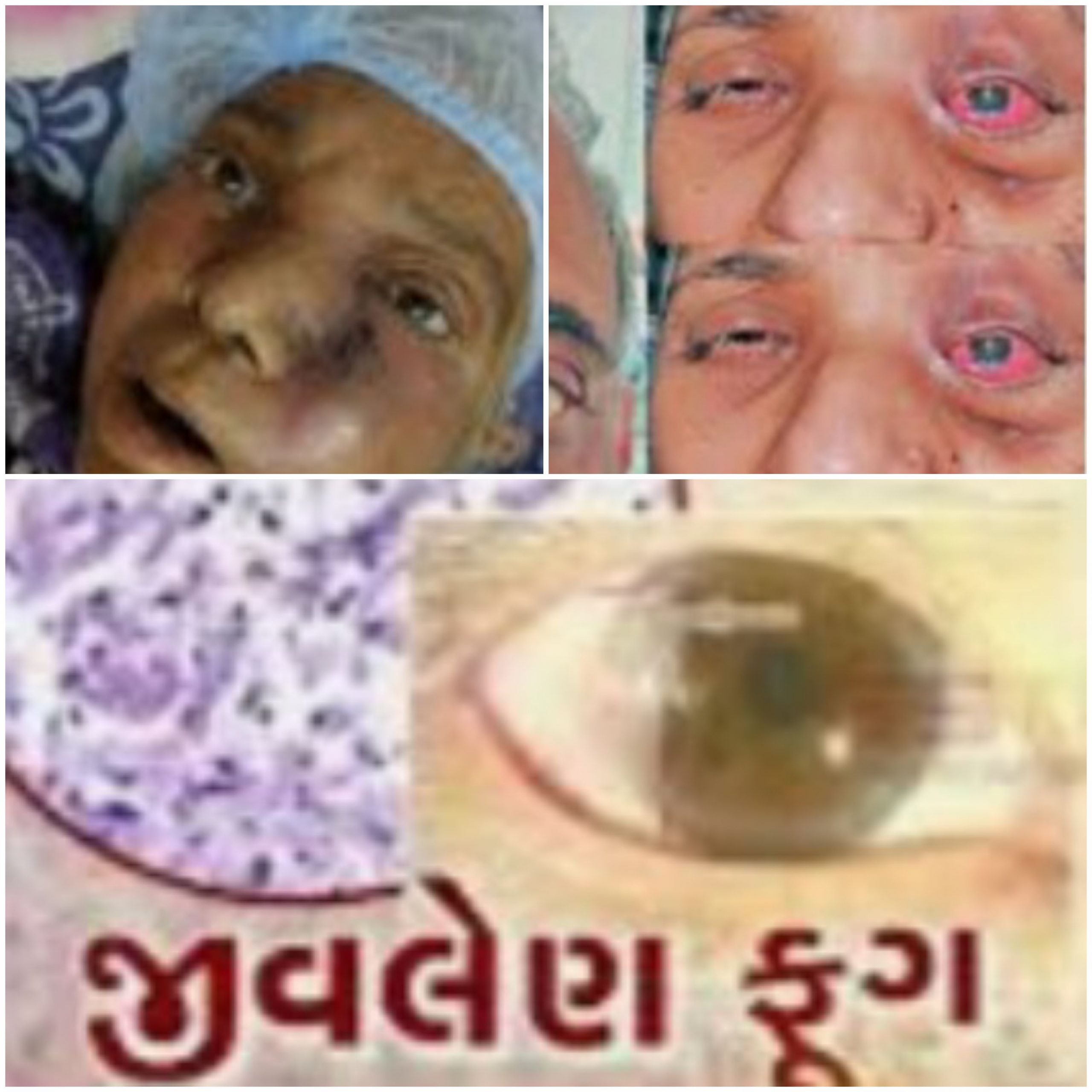 વલસાડ જિલ્લા વહીવટી તંત્ર મ્યુકરમાયકોસિસ રોગ સામે એલર્ટ,ગાંધીનગર થી સૂચના અપાતા તંત્ર દોડતું થયુ 20201223 080615 Scaled Satya Day