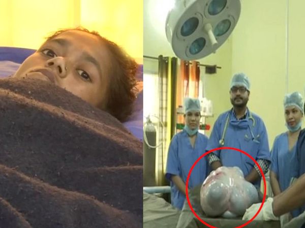 OMG: 6 કલાકની સર્જરી બાદ 16 કિલોનું ટ્યૂમર કાઢવામાં આવ્યું 4 1616392268