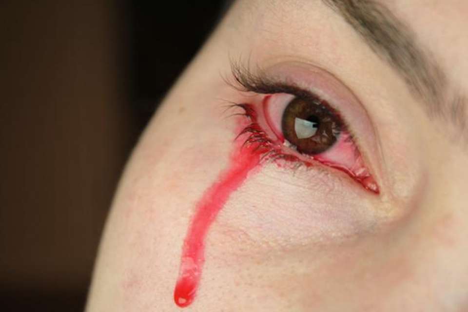 OMG: મહિલાની આંખમાંથી પડે છે લોહીના આંસુ ! BLOOD TEARS3 960x640 1