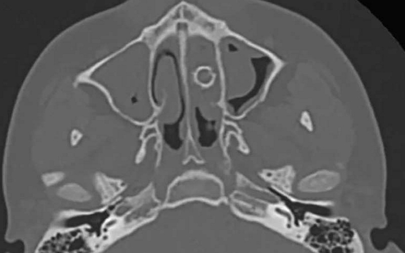 bullet in boy nose