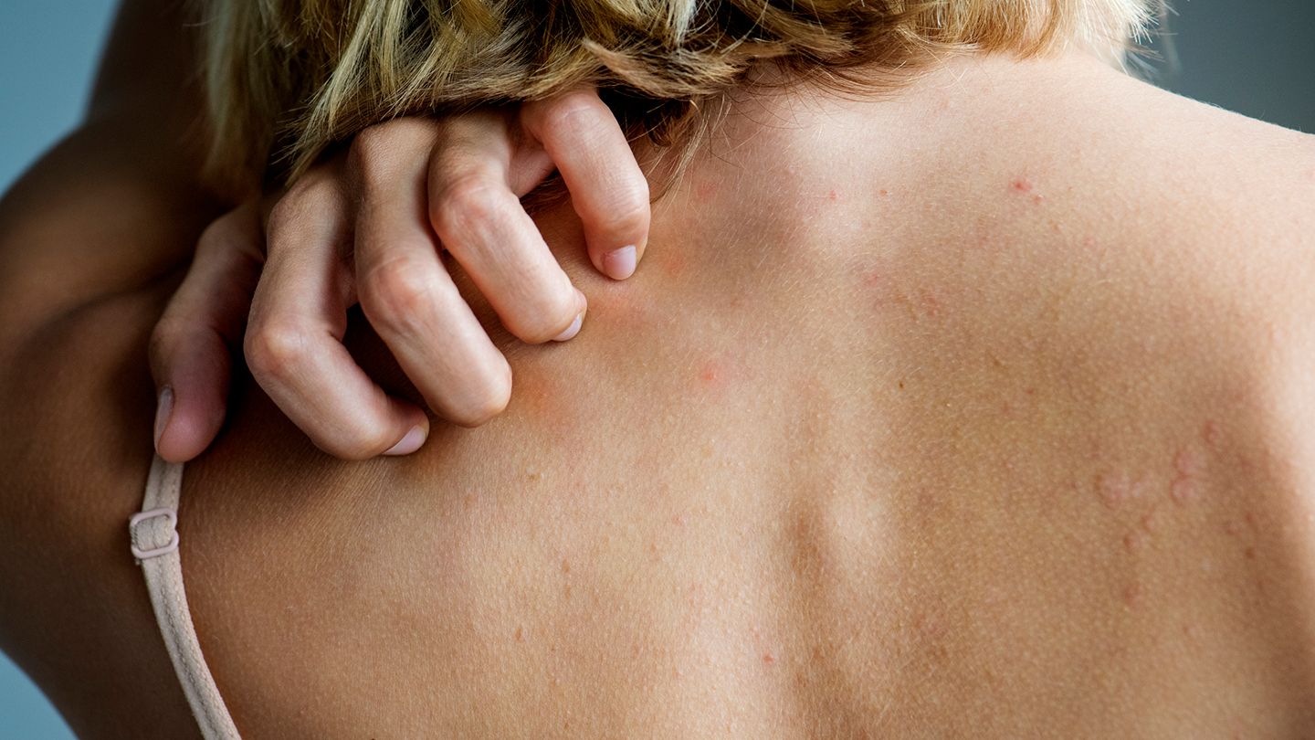 HEALTH: ગરમીમા ફોલ્લીઓ અને રેડનેસથી મેળવો રાહત ! Common Types Of Rashes 00 1440X810 1 Satya Day
