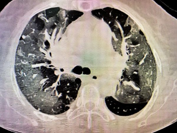 HEALTH: 20 વર્ષમાં રોજ 20 સિગારેટ પીવાથી થતું નુકસાન બીજી લહેરનો વાયરસ 2થી 3 દિવસમાં કરે છે Orig 15 1618005091 Satya Day