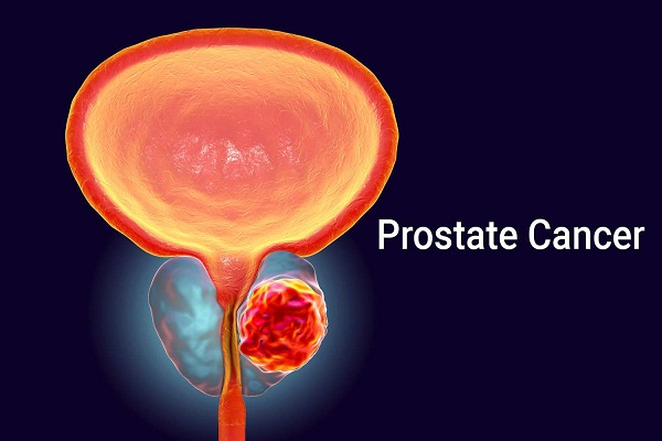 Prostate Cancer