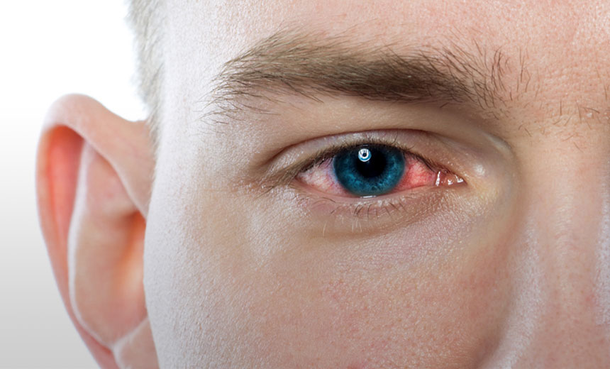 Eye Infection Satya Day