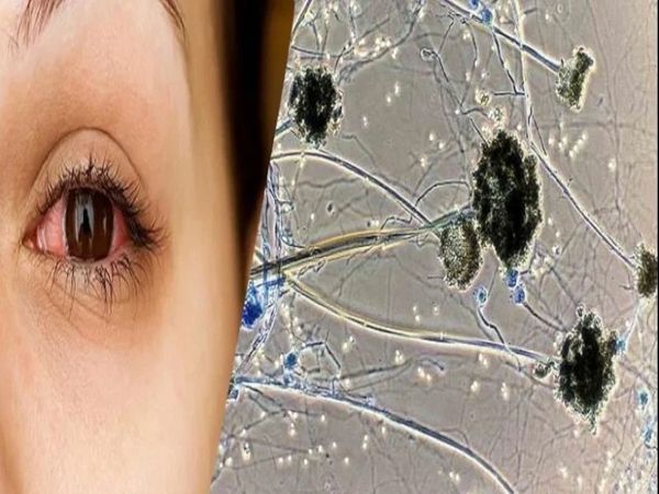 WEIRD: ડોકટર્સે કેન્સરની ગાંઠ સમજીને ઓપરેશન કર્યું તો 10 સેમીનું ફંગસ નીકળ્યું ! 7 9