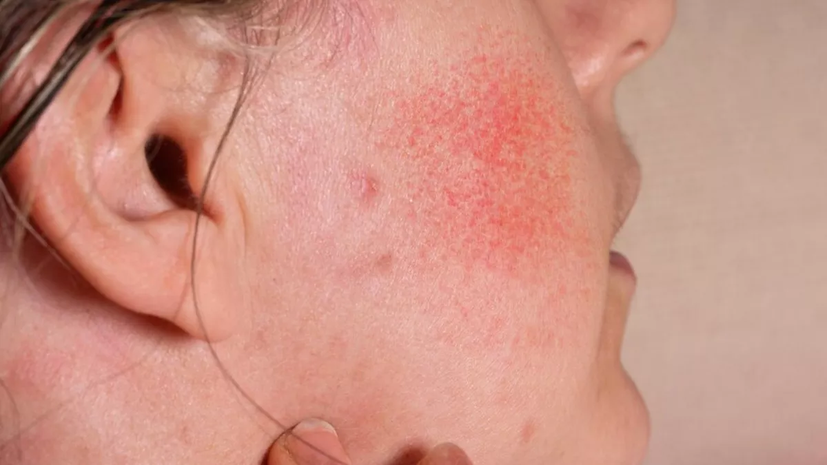 winter red cheeks