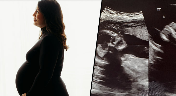 there are two wombs inside a woman children are developing in both