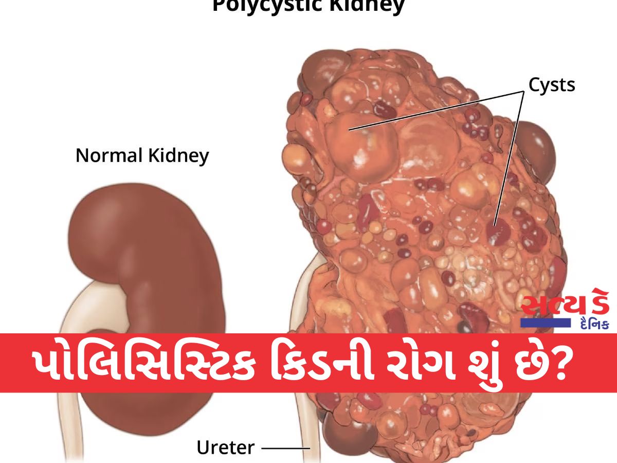 Polycystic Kidney