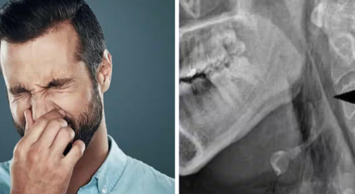 The Horrible Consequence Of Stopping A Sneeze Is A Hole In The Trachea Satya Day