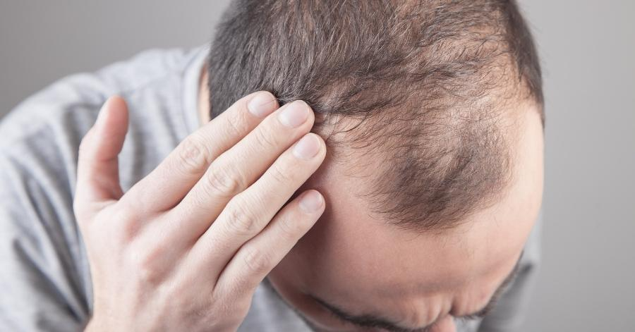 if your hair is falling rapidly then know which vitamin deficiency you may have