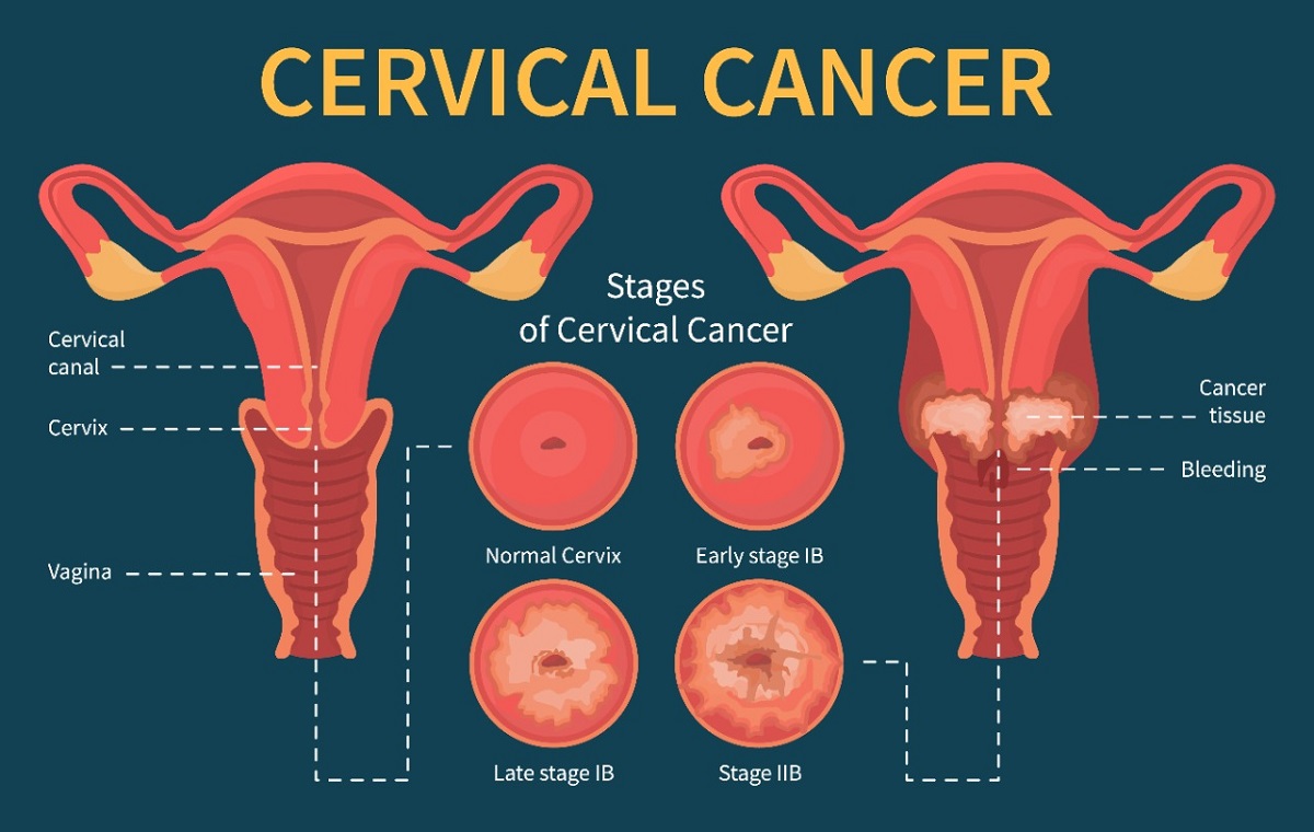 Cervical cancer