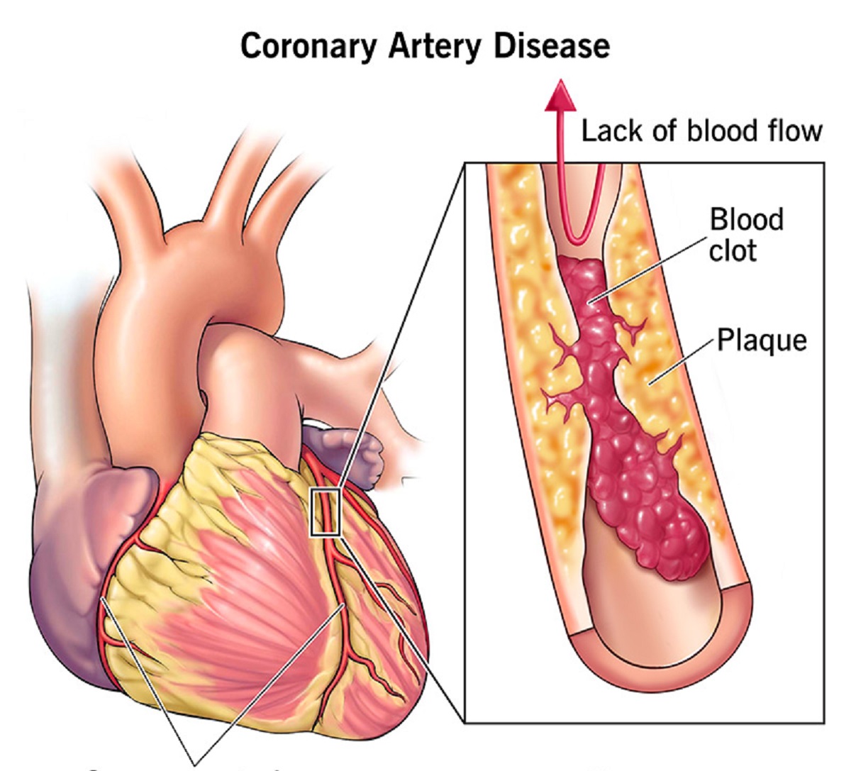 Heart Blockage.1