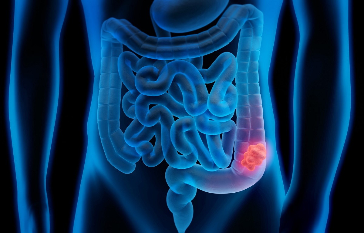 colon cancer.2