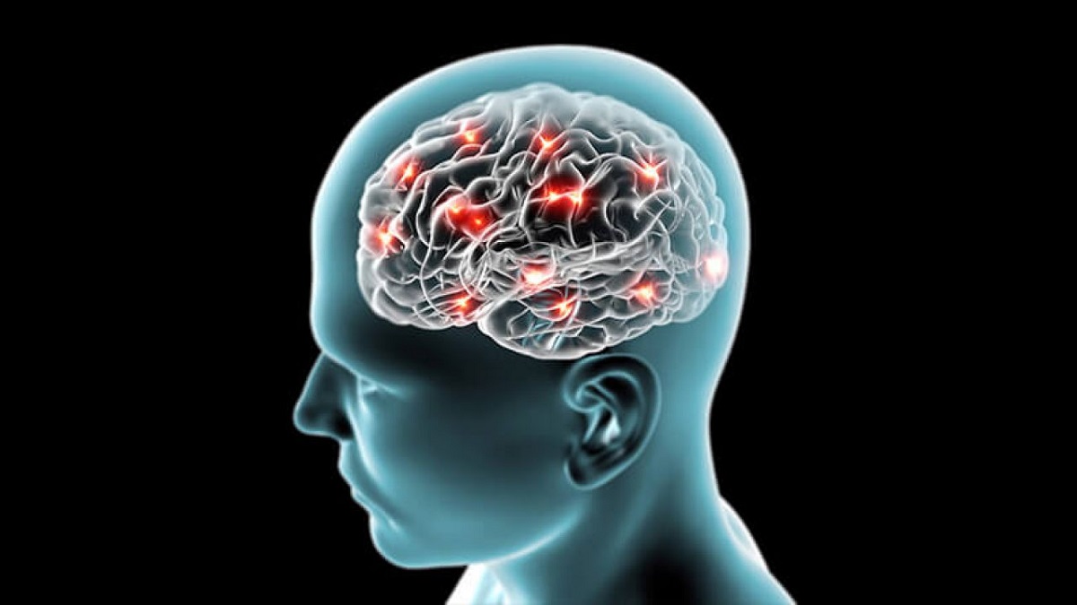 Brain Stroke.1 1