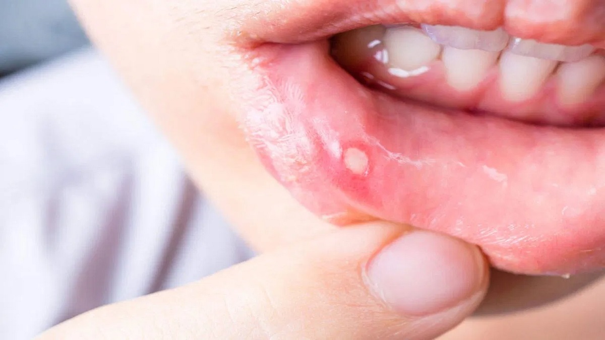 mouth ulcer