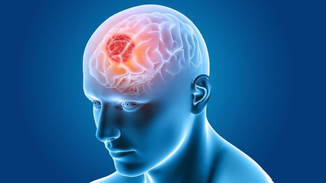BRAIN TUMER.1 1