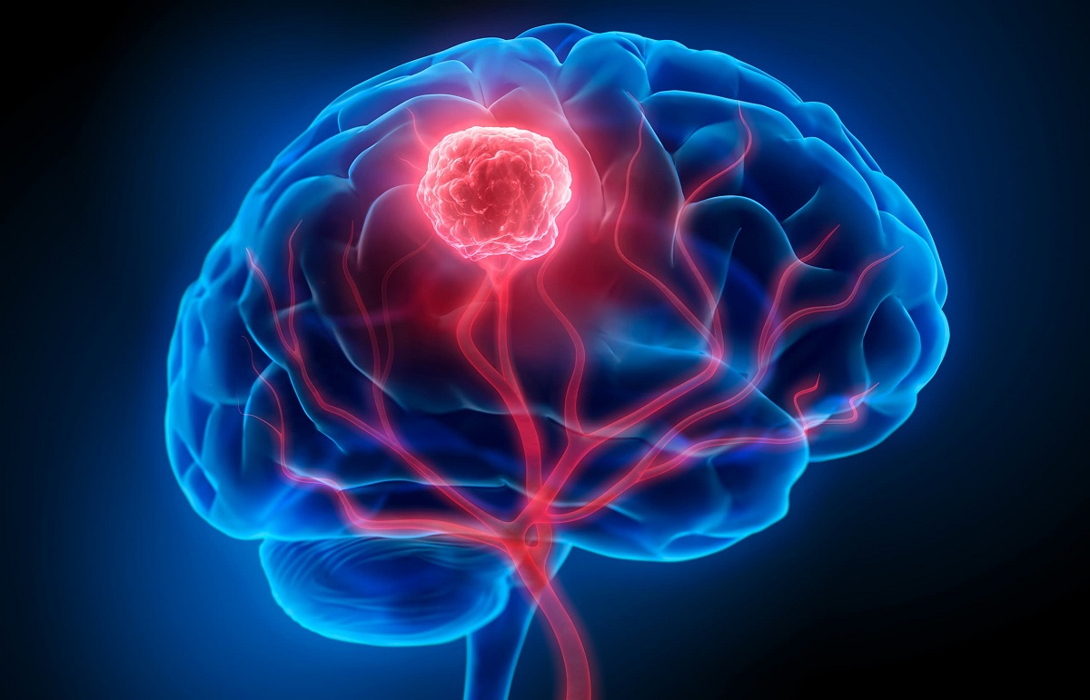 BRAIN TUMER.2
