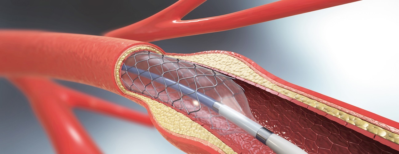 Angioplasty Satya Day