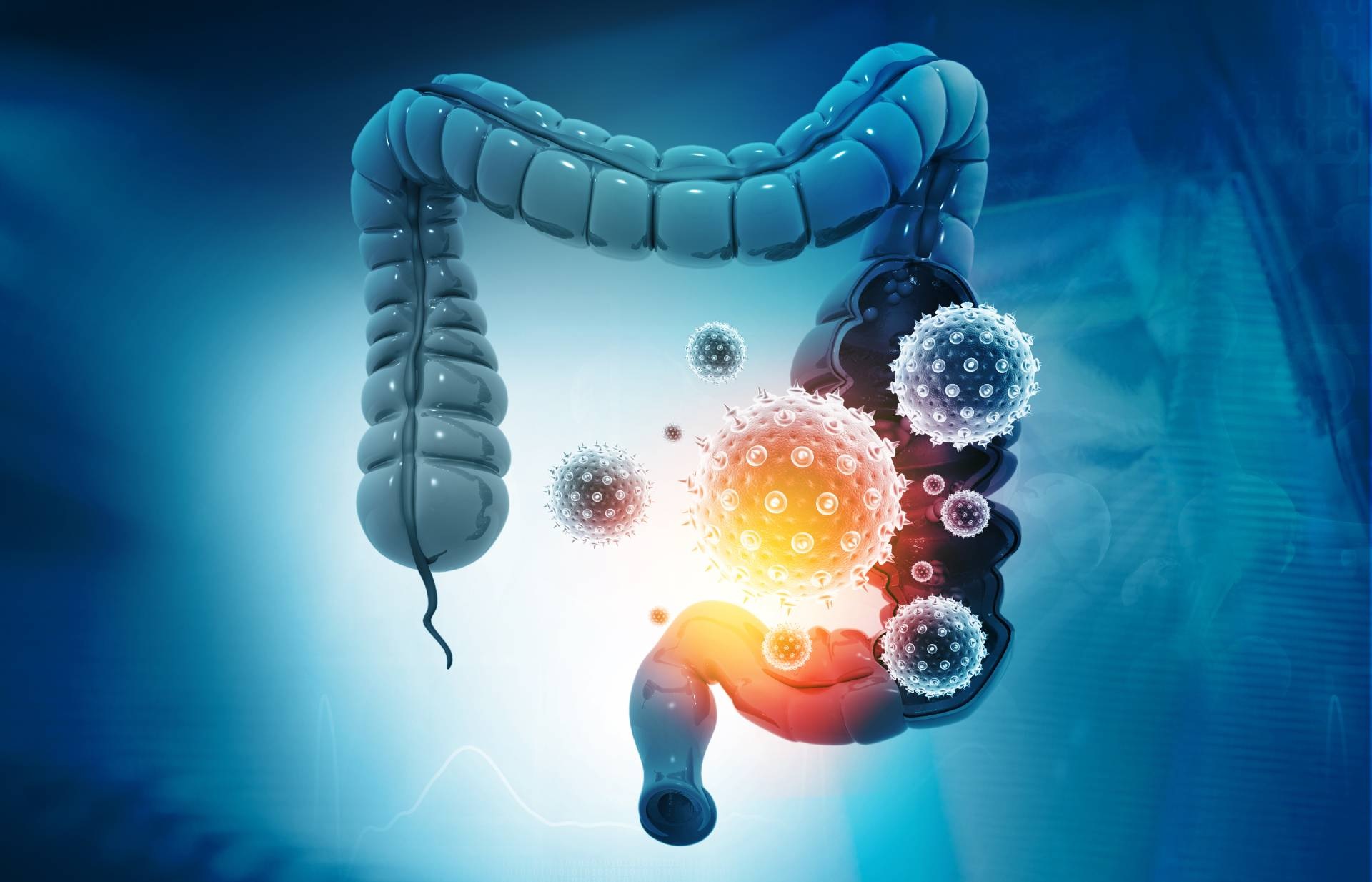 colon cancer