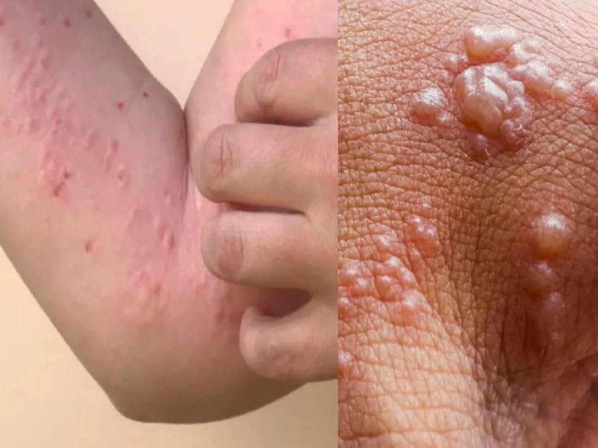 monkeypox 1