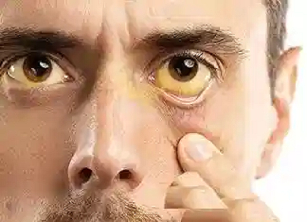 Jaundice- Health tips