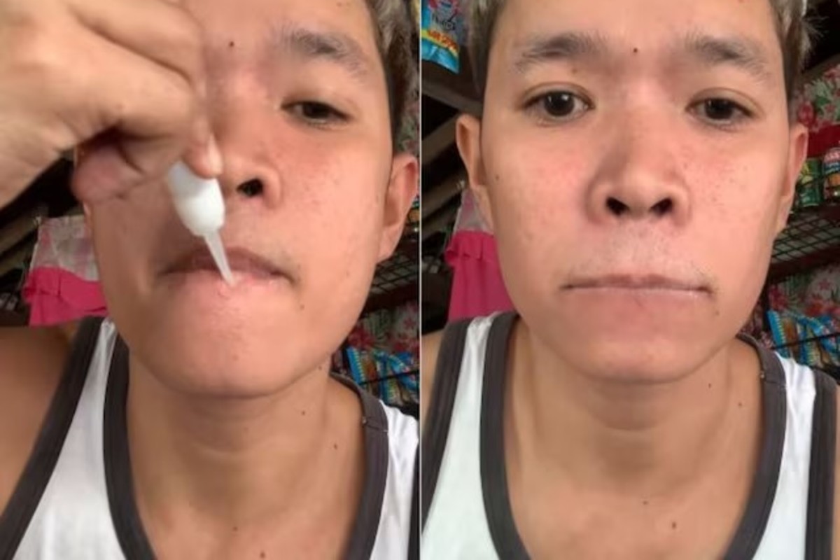Boy super glue lips viral video
