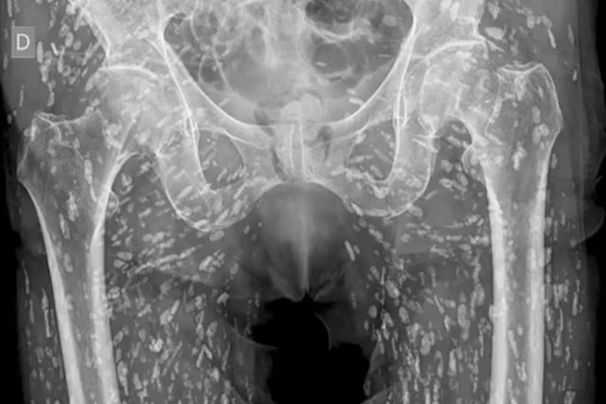 Doctor Shocked To See Man X-Ray