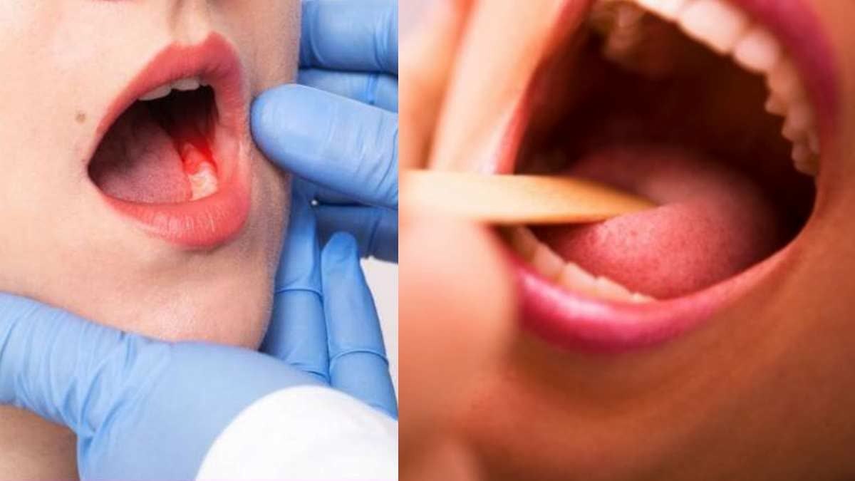 Oral Cancer