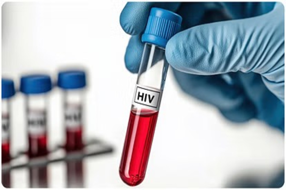 Hiv &Amp; Aids