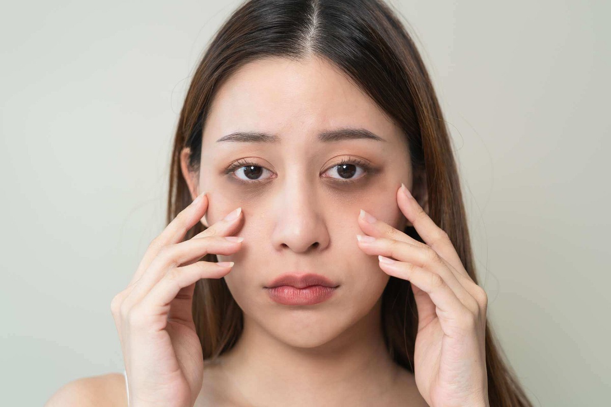 Dark Circle Home Remedies