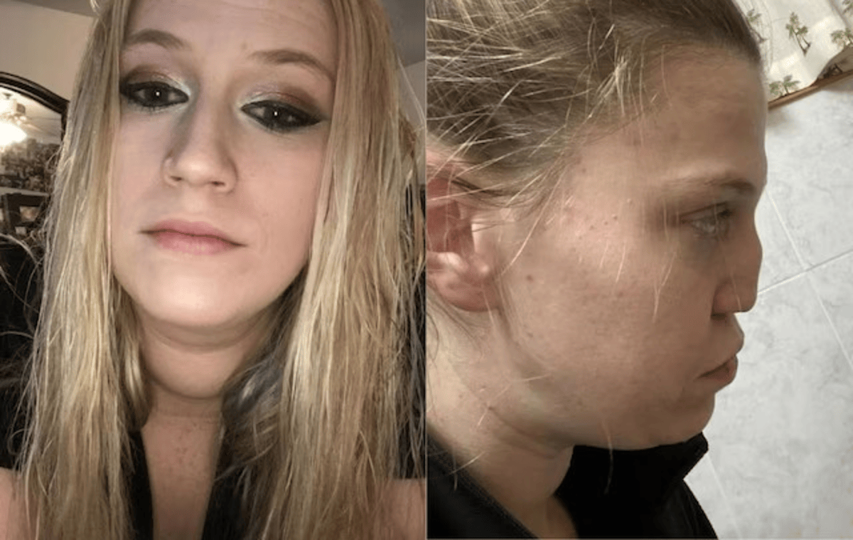Woman Got Hole On Face Drugs Addict