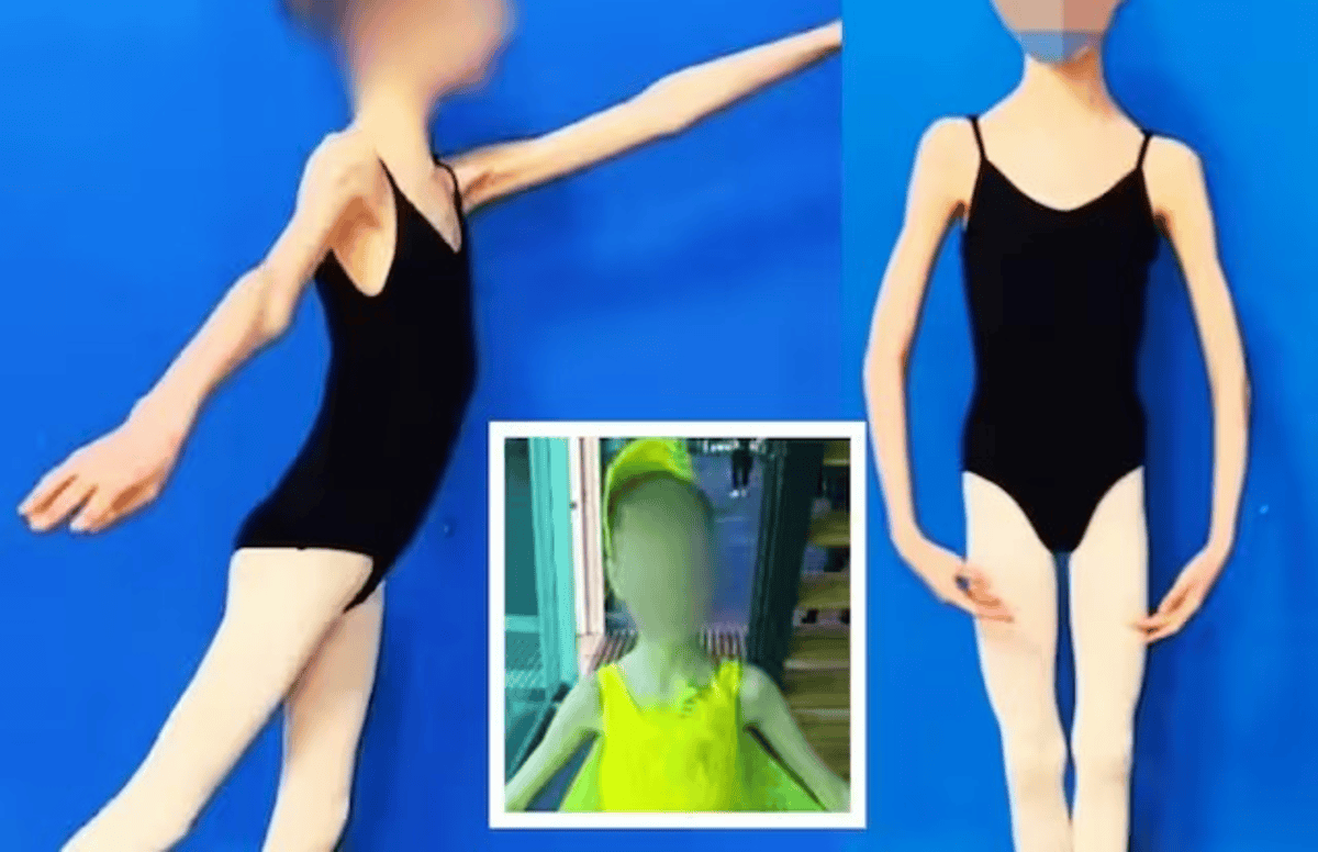 17year old girl weighs only 25kg
