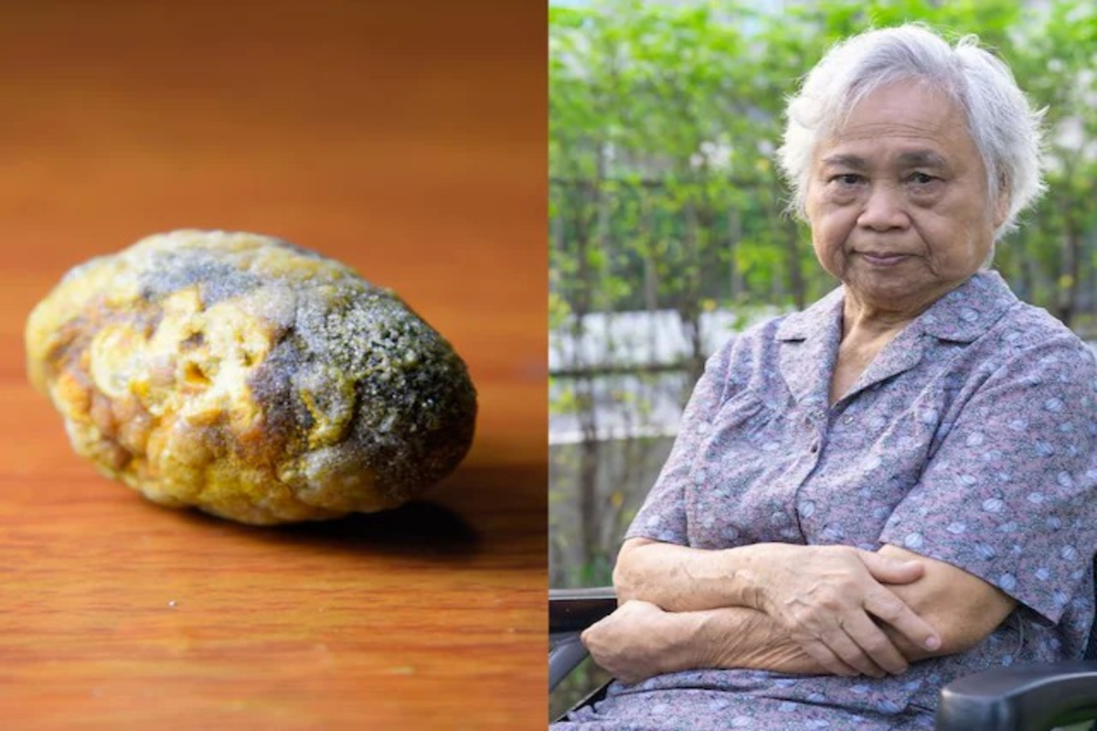 Apple Sized Stone Found In Woman Stomach