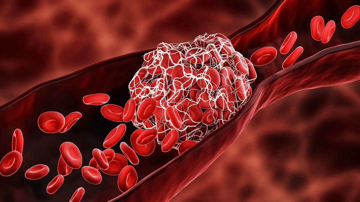 BLOOD CLOT