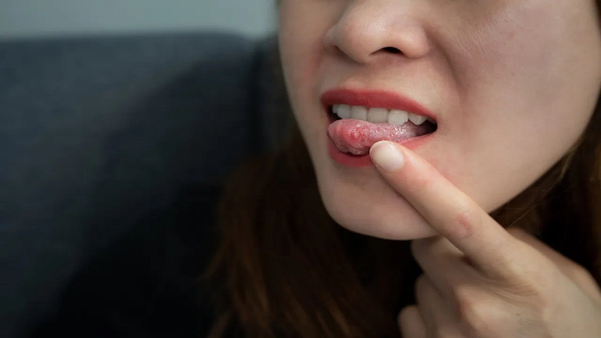 Oral Cancer Symptoms