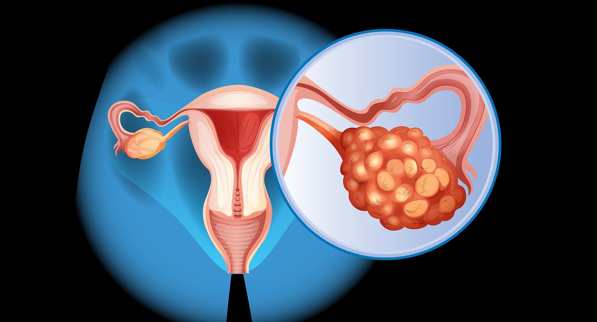 Ovarian Cancer