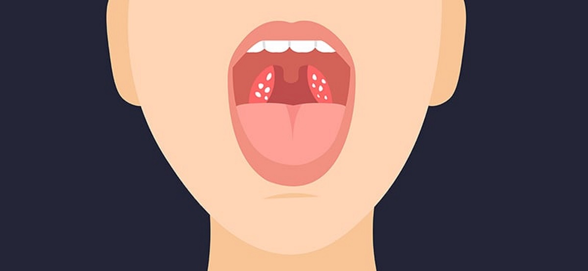 Tonsil Stones