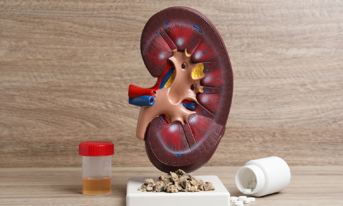 Kidney Stone