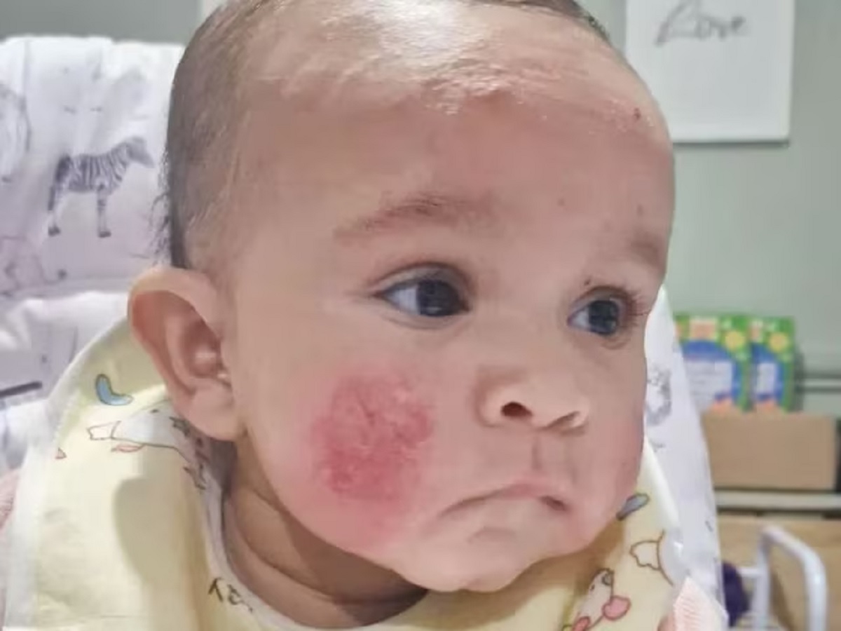 6 Month Girl Get Itchy So Face