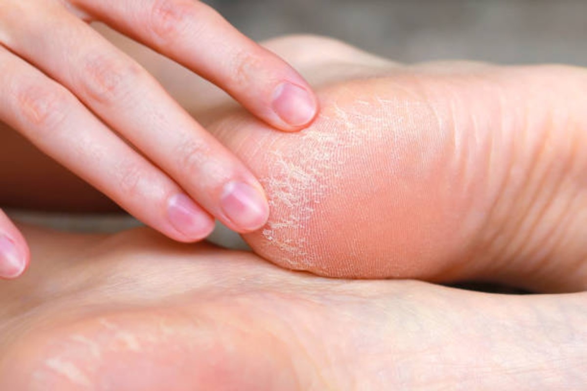 Cracked Heels Remedy