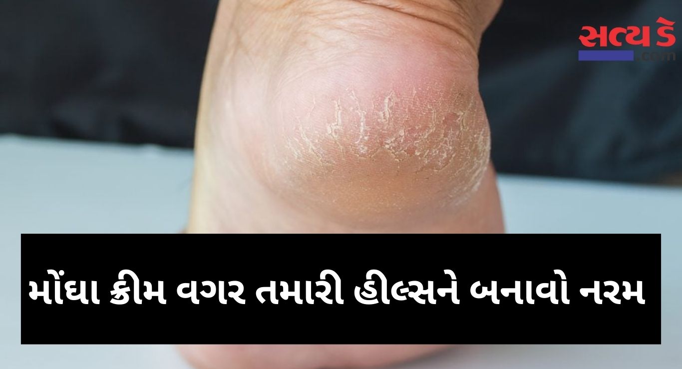 Cracked Heels Remedies