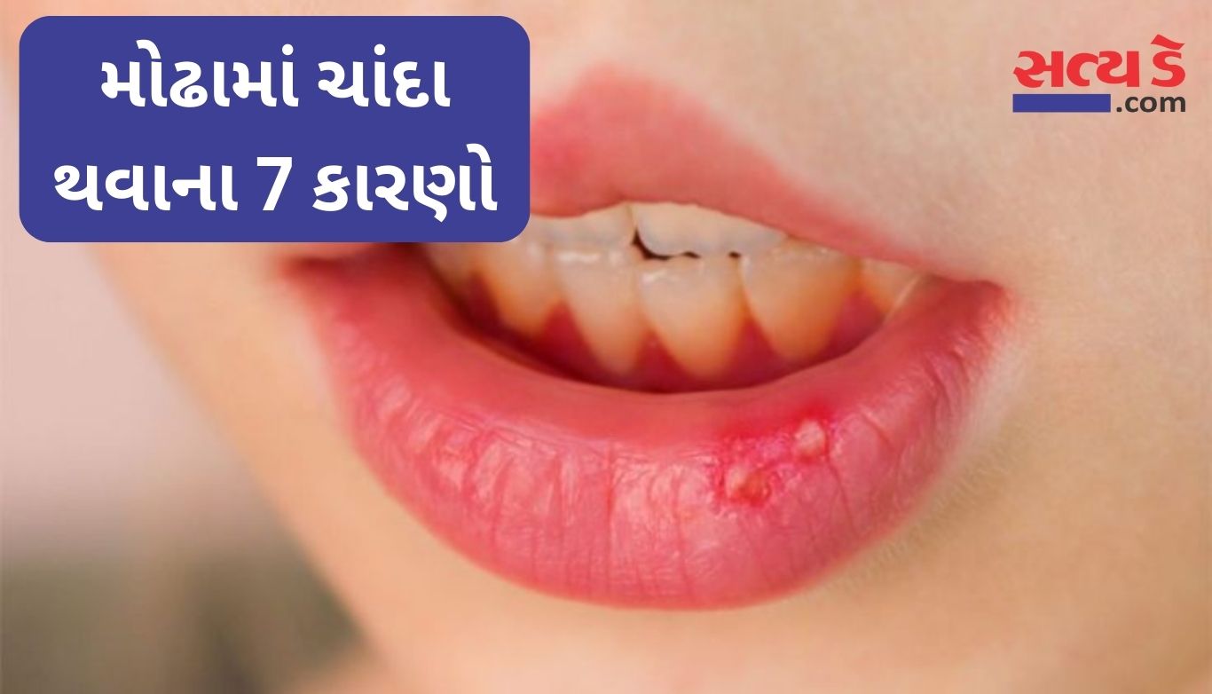 Mouth Ulcer