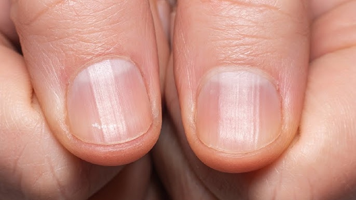 Lines On Nails