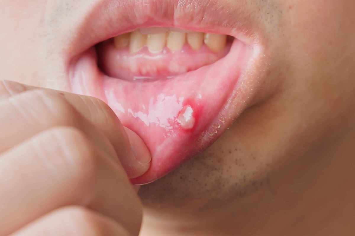 Mouth Ulcer Cancer